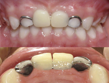 PROTESIS PREDIATRICAS DENTALES